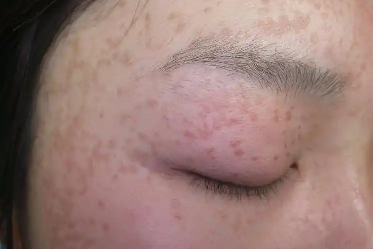 烦人的损容性皮肤病——"小肉疙瘩"-健康160