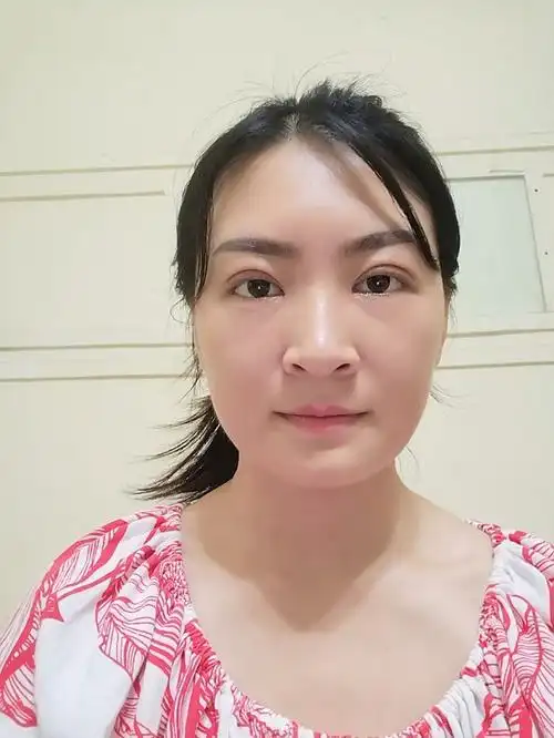 做完双眼皮第20天的效果图,现在正常看东西眼皮有拉_圈子-新氧美容