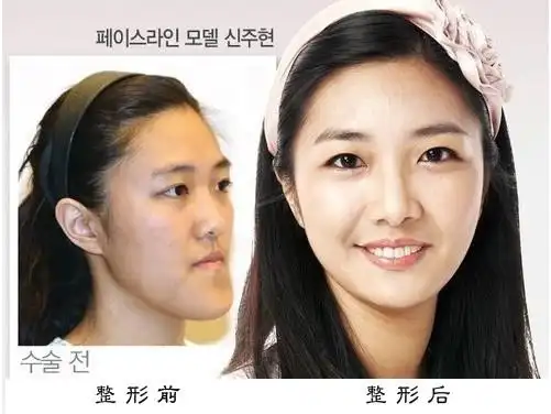 整形前后对比照