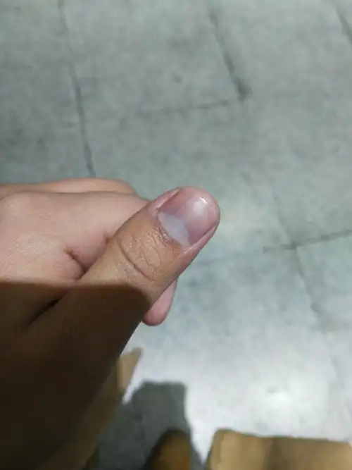 附件:最近发现手指甲月牙上发紫病情描述:性别:男年龄:20岁