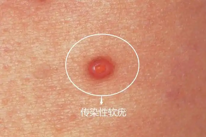 传染性软疣