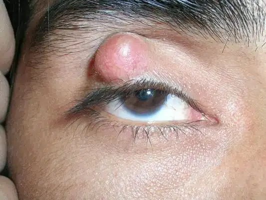 眼皮上长了个疙瘩图片 (13)_有来医生