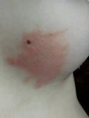 孕二十九周多了,乳房边上长了这个,出汗就会有点痒,这是怎麼了?