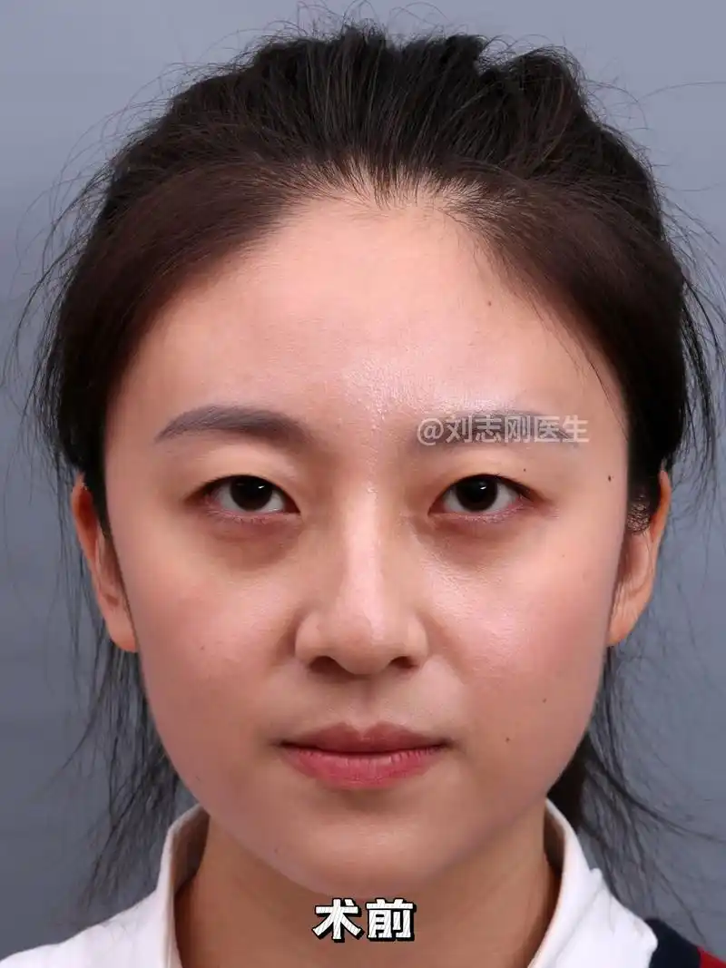 从单眼皮→双眼皮,旧貌换新颜.小姑娘眼部基础不错,眼皮厚薄适 - 抖音