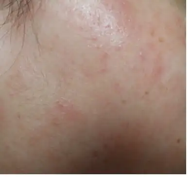 用化妆品(浪漫香榭丽3号),脸部皮肤过敏,怎么办?