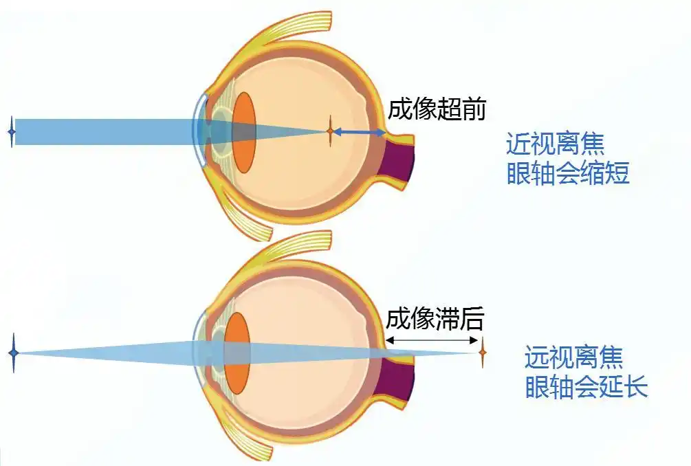 眼睛可以感知到成像点的位置,并去"追光",所以近视防控的主要理念,就