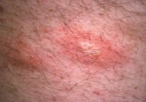 男人睾丸上长硬疙瘩图片及原因