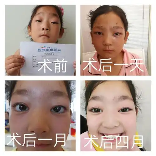 成人上睑下垂手术是双重睑手术的升级版,手术的