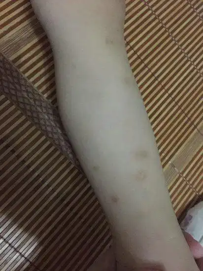 皮肤出现这些信号警惕高血糖 色素沉着应注意