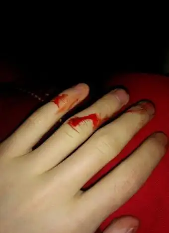 手出血的图片 (39)_有来医生