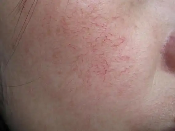 红血丝病发后的护理措施具体有哪些