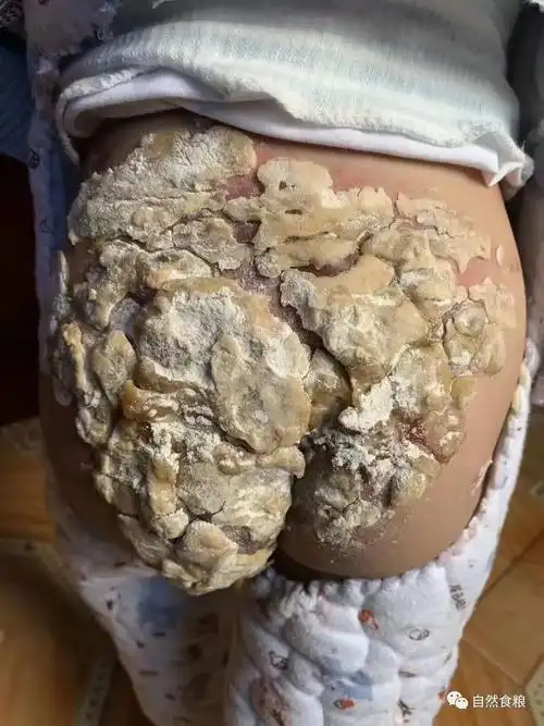 烫伤紧急处理法——冷水和面糊涂上去