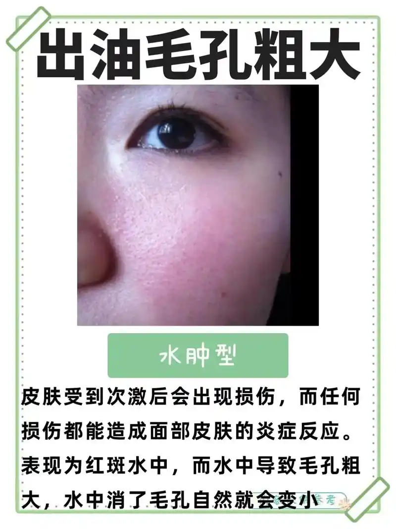 出油毛孔粗大.水肿(炎症)型毛孔粗大,红斑水肿,如红痒,毛孔 - 抖音