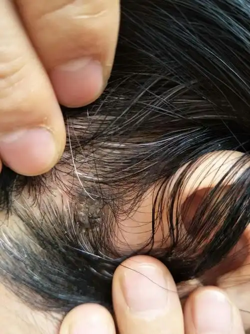 张医生您好我头皮上长一黑东西不疼不痒曾用手取下过结的痂