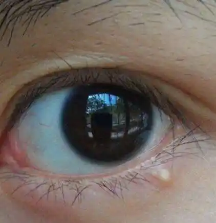 眼底下长脂肪粒怎么治6个方法教你去除脂肪粒