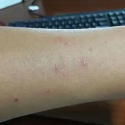 硬下疳初期图片8