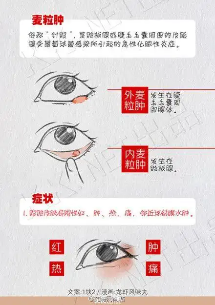 麦粒肿俗称针眼,又痒又疼,眼睛发肿,难以睁开眼睛