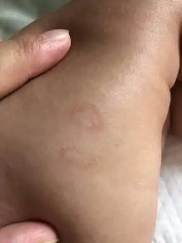 宝宝大腿内侧外侧有这种圆形的皮疹,不知道是什么～这个位置是纸尿裤