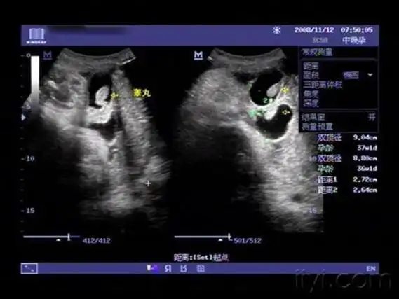 孕26周四维下睾丸的样子 如何看四维彩超识性别