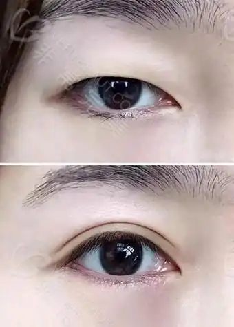做双眼皮埋线和全切哪个效果好?解析如何挑选更适合自己的眼整形方式!