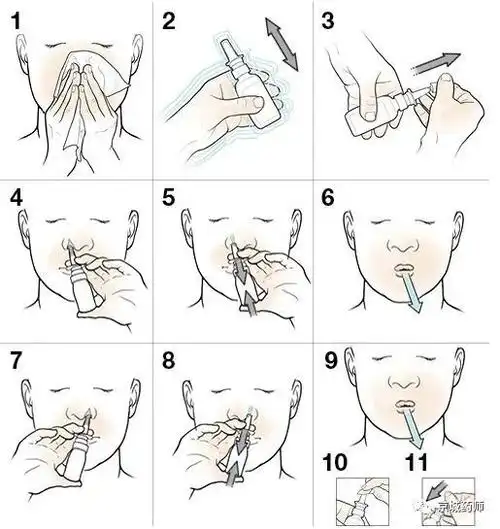 此外,激素鼻喷剂早晨给药为好,尽量降低药物对生理激素分泌的影响;若