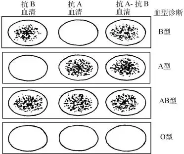血型红细胞和血浆凝集规律