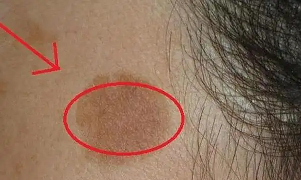 为什么年纪大的人身上会出现老年斑?