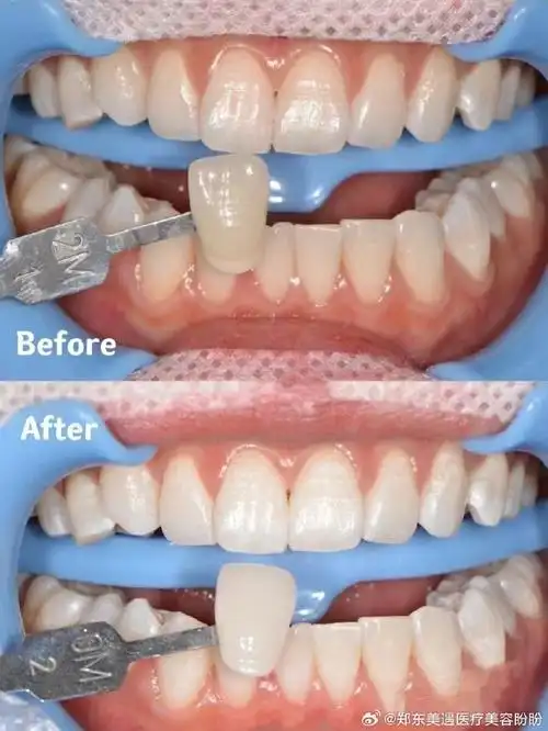 郑东美遇冷光美白三次后效果前后对比90价格68890#郑东美遇##郑东