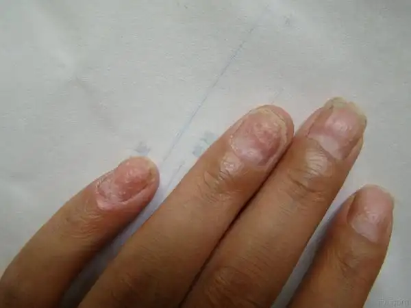 银屑病顶针样甲