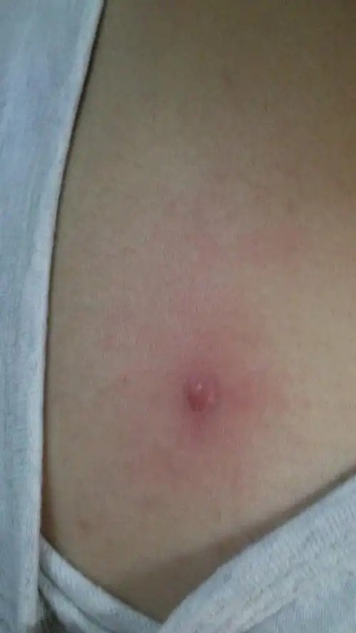 背上长了个痘痘这是什么情况