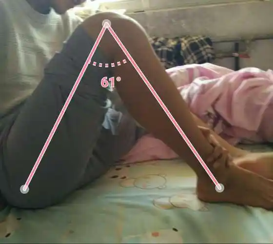 大夫您好,我现在手术完23天,基本上没怎么掰腿就到了120度-袁锋副主任