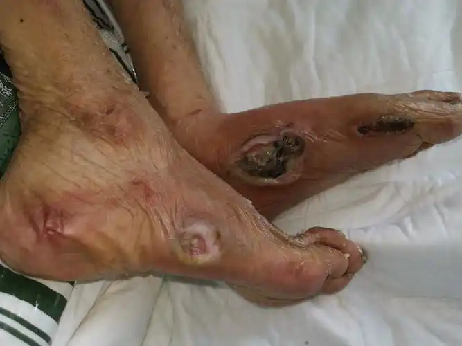 双足压疮～皮肤坏死感染