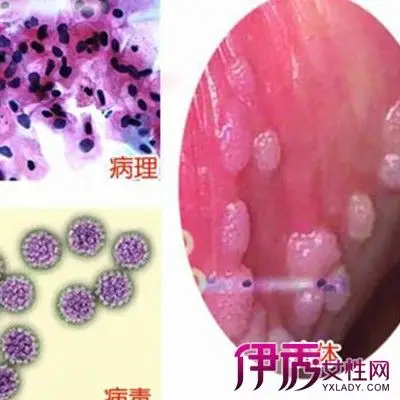 【图】展示假性尖锐湿疣图片 几个妙招教你如何预防该病