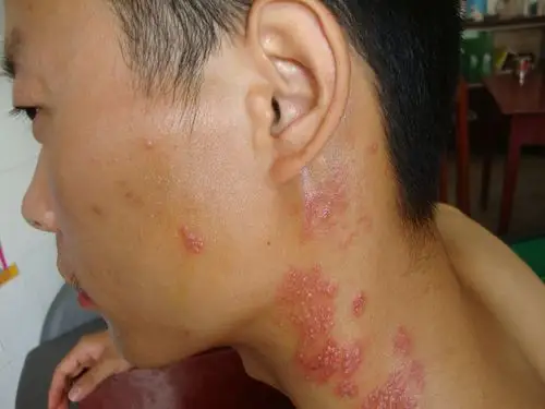 蚰蜒刺伤性皮炎(玉精性皮炎) - 皮肤及性传播疾病讨论版 - 爱爱医医学