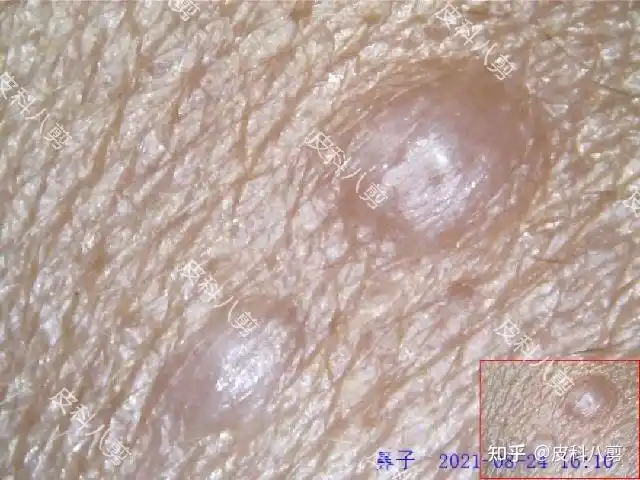 皮科小八医生毛发上皮瘤