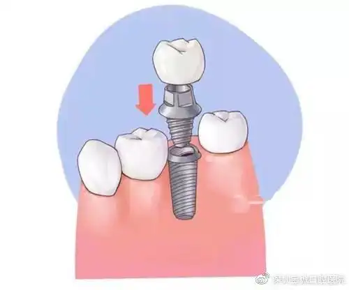 种植牙到底可以用多久