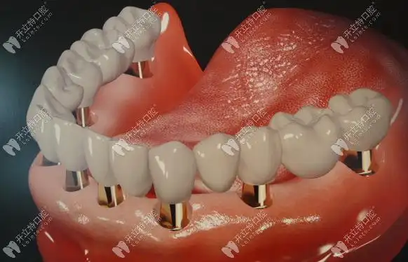 2022上海全口种植牙费用已出用马泷桥做全口登腾在什么价位
