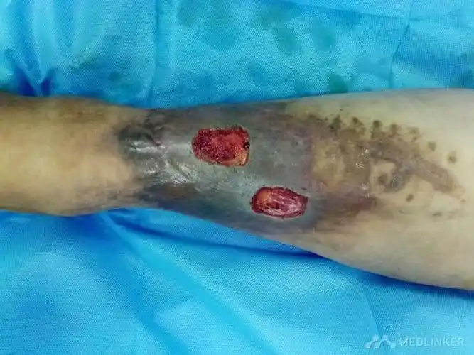 小腿皮肤溃疡-医联