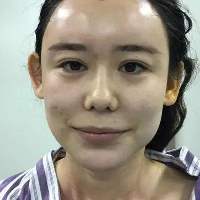 自体脂肪填充太阳穴术后果展示图片