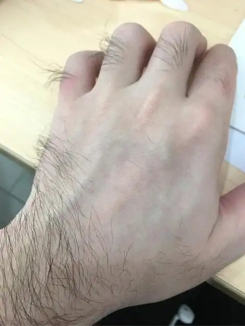 体毛多的人阳气真的比较足吗纯中医对此摇头苦笑