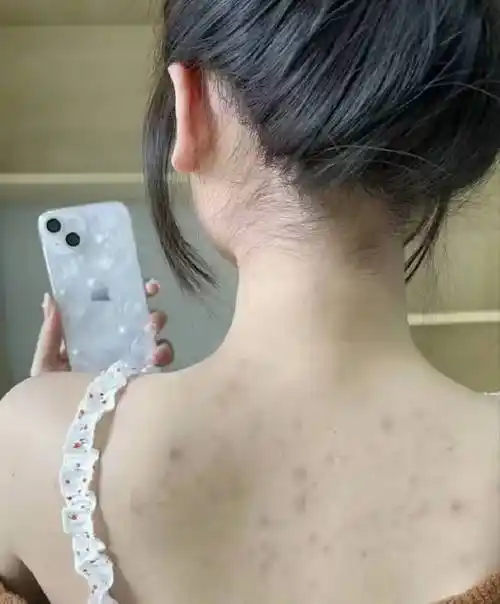 后背爆痘流脓和螨虫说不过来人教你三招轻松重拾牛奶肌