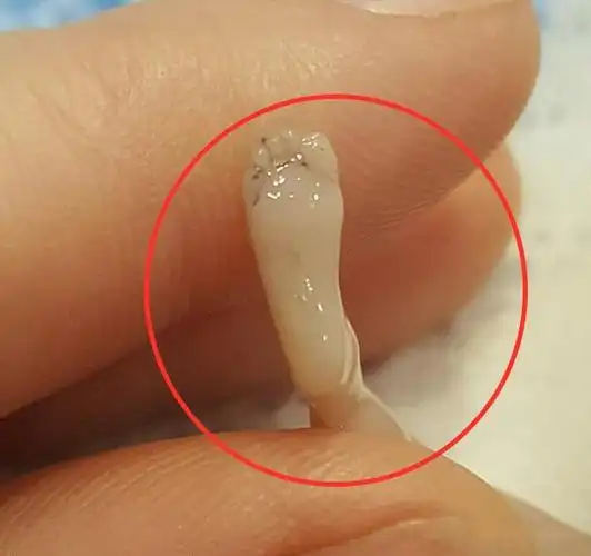 女子怀孕14周后流产,"胎儿"照片曝光,仅10厘米但手脚都已成型