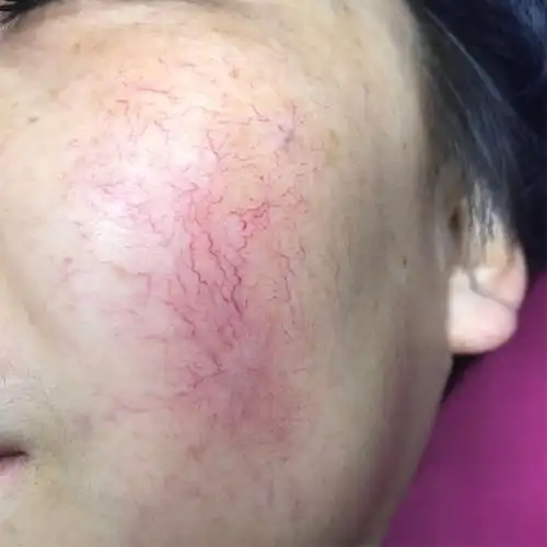 激光去不掉红血丝是真的吗?