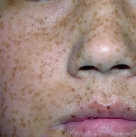 儿童脸上长雀斑的症状