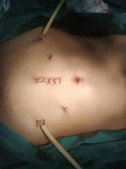 其它 乘风破浪,努力向前 写美篇经科室术前讨论,拟行腹腔镜辅助直肠