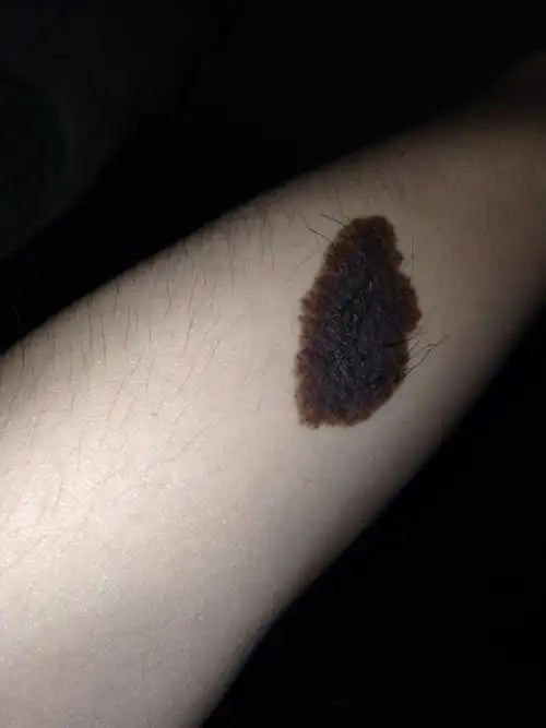 对于黑毛痣的治疗,国内采取切除,国外有没有什么先进的方法?广告勿来