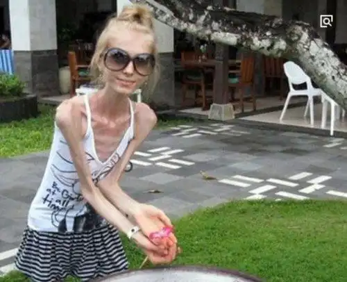 世界上最瘦的女人身高158厘米体重却只有20公斤像干尸