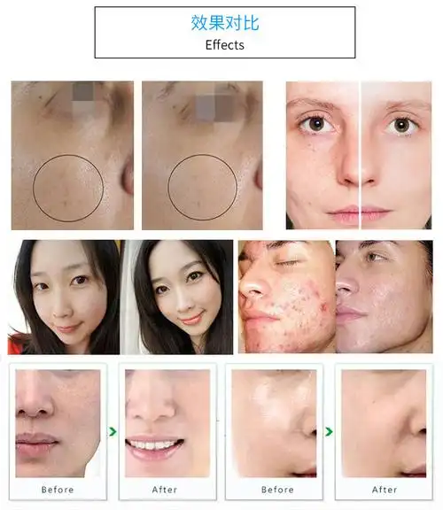 多功能高氧护理仪使用前后对比图