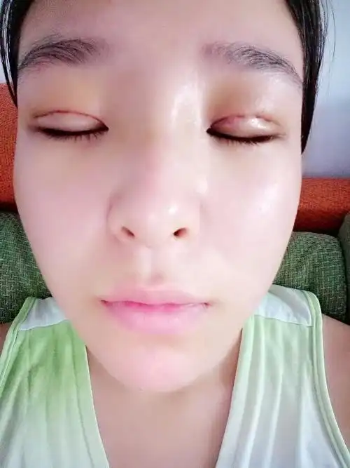 今天是我做完埋线双眼皮的第四天,消肿了很多,但是晚上睡觉和起床的
