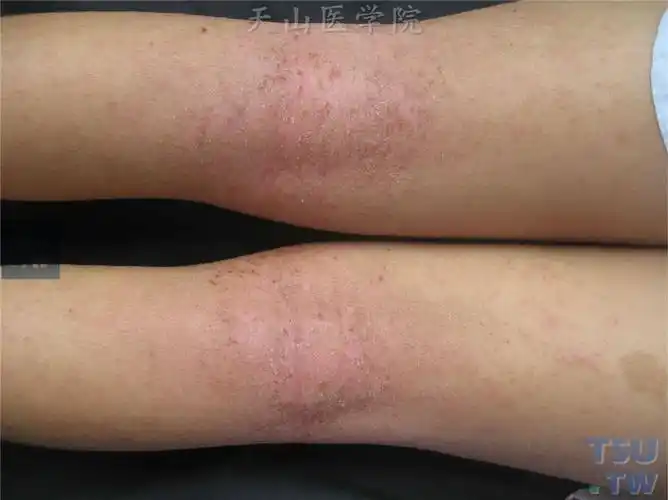 特应性皮炎atopicdermatitis的症状表现